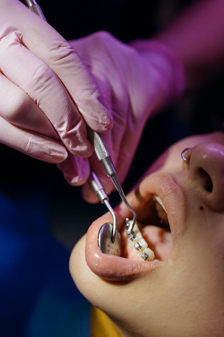 Close up teeth examination represent orthodontic help